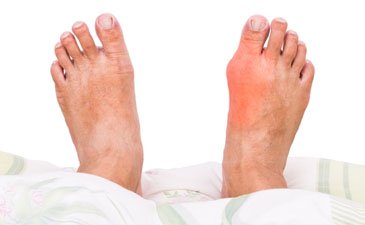 Gout Treatment in Delhi